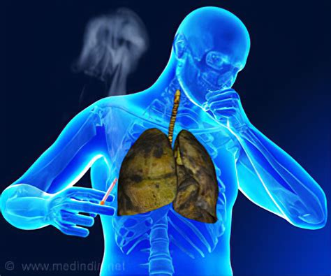 Tuberculosis